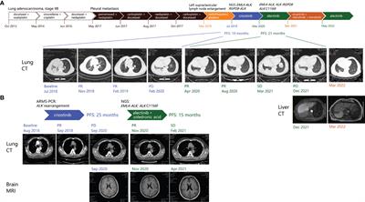 Case report: Durable response to alectinib in ALK-rearranged lung adenocarcinoma with acquired, crizotinib-resistant ALK C1156F mutation